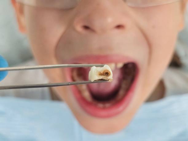 Best Emergency Dental Extractions in Hernando Beach, FL